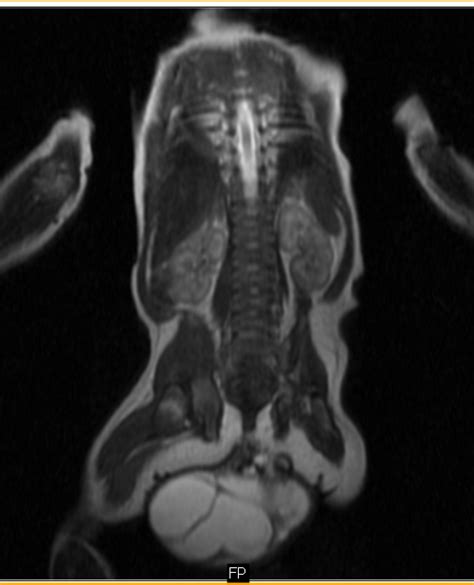 SACROCOCCYGEAL TERATOMA - Sumer's Radiology Blog