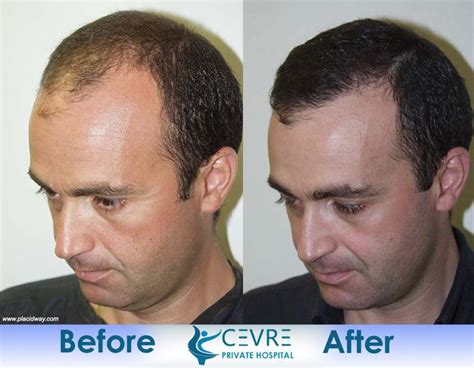 Before and After Hair Transplantation | Turkey FUE Istanbul