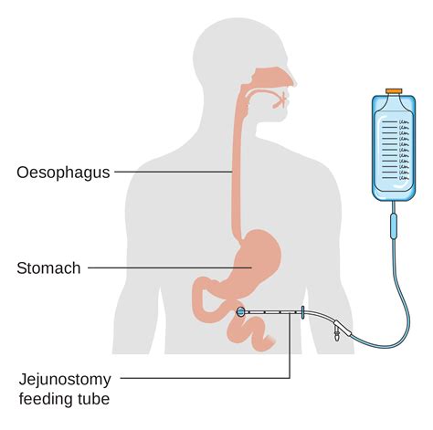 Feeding Tube Into Small Intestine