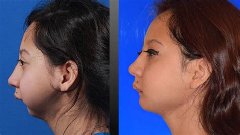 Teen gets new jaw in historic surgery