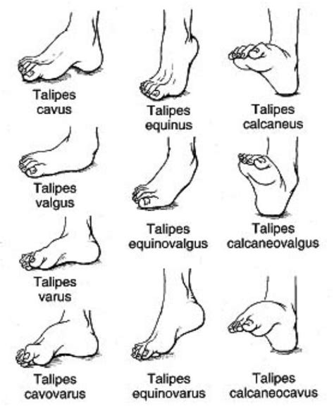 Foot deformities- various talipes conditions. | Pediatric physical therapy, Pediatric nursing ...