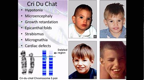 Pathophysiology 16 Chromosomal abnormalities - YouTube