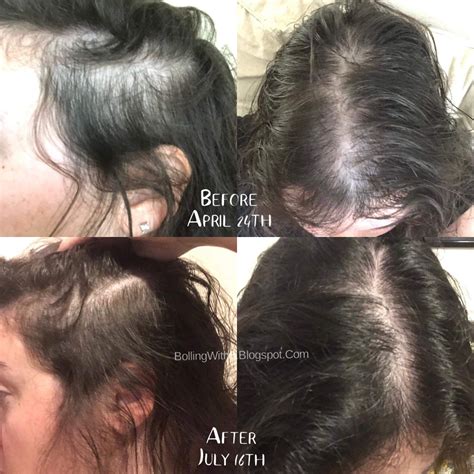 Bolling With 5: HairCovery Hair Serum Results!