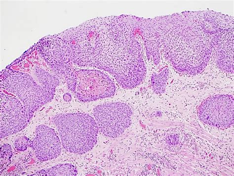 Esophageal Squamous Cell Carcinoma Histology