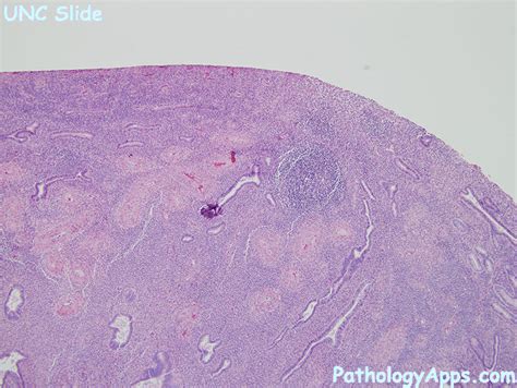 endometrial polyp pathology