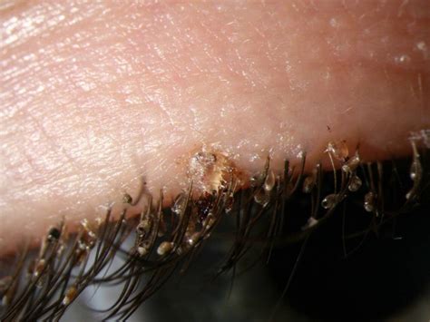 Lice infestation on eyelids Archives | DailyPedia