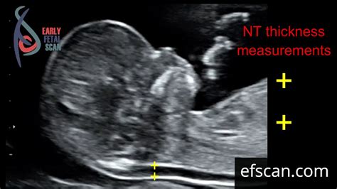 Ultrasound Fetal Measurement Chart