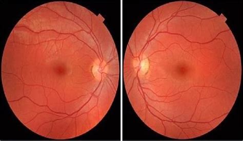 Fundus image of normal eye [18]. | Download Scientific Diagram