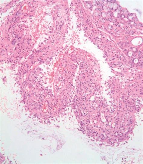 Mucocele Histology