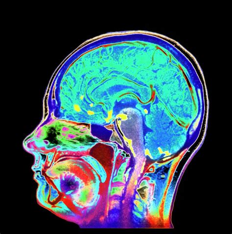 Meningitis Brain Scan Photograph by Simon Fraser/newcastle Hospitals ...