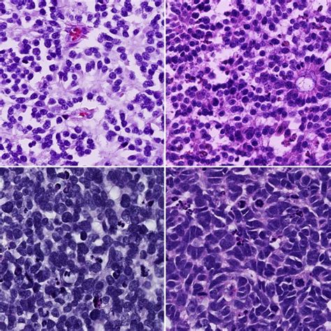 Histopathologic Grading of Anaplasia in Retinoblastoma | Ento Key