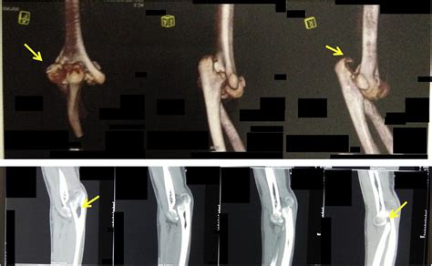 2D and 3D CT Scan reconstruction of the left elbow. | Download Scientific Diagram