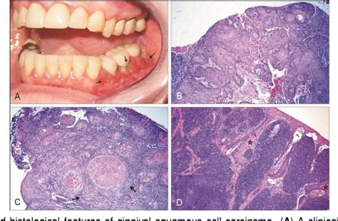 Figure 1 from Presence of Porphyromonas gingivalis in gingival squamous ...