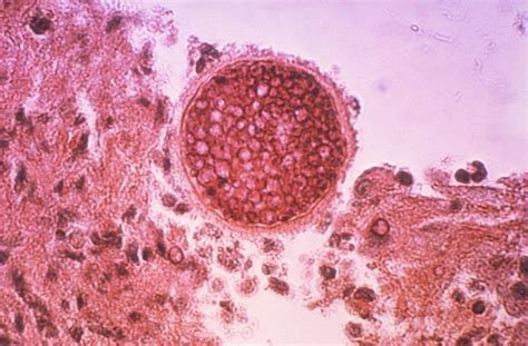 Coccidioidomycosis pathophysiology - wikidoc