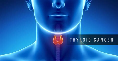 Thyroid Cancer Causes and Risk Factors