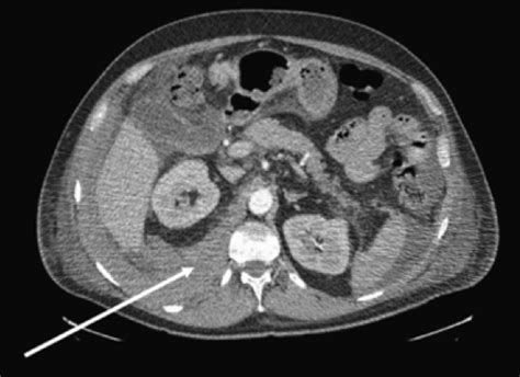 emDOCs.net – Emergency Medicine EducationRetroperitoneal Hematoma in the ED - emDOCs.net ...