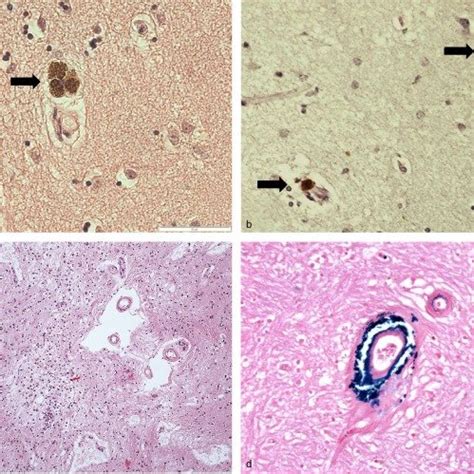 (PDF) Brain haemosiderin in older people: Pathological evidence for an ischaemic origin of ...