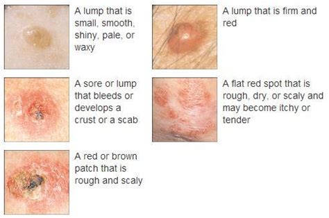 Skin Cancer Symptoms