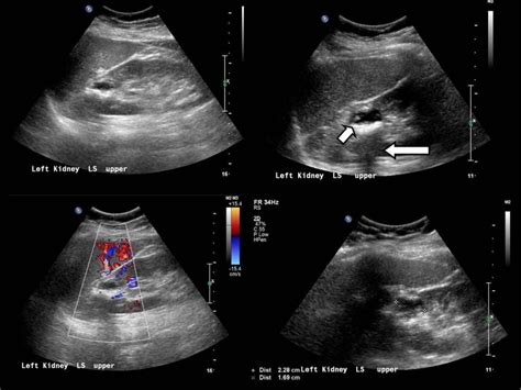 Figure 2 from Calyceal diverticulum - a mimic of different pathologies ...