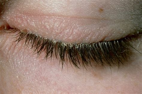 Blepharitis - NHS.UK