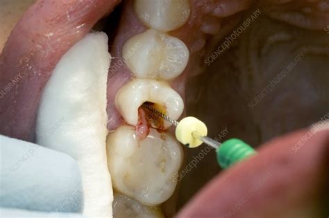 Root canal dental surgery - Stock Image C029/0466 - Science Photo Library