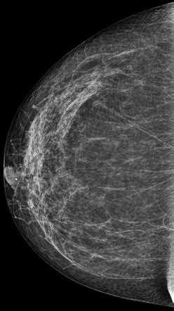 Normal mammography: scattered areas of fibroglandular density | Radiology Case | Radiopaedia.org