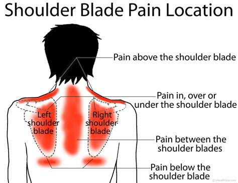 Shoulder / ПЛЕЧИ: Shoulder Blade (Scapula) Pain