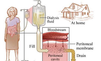 Uremia - Signs, Symptoms and Treatment