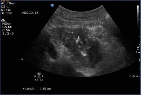 Ascending colon carcinoma. Probe place at right hypochondrium, probe... | Download Scientific ...