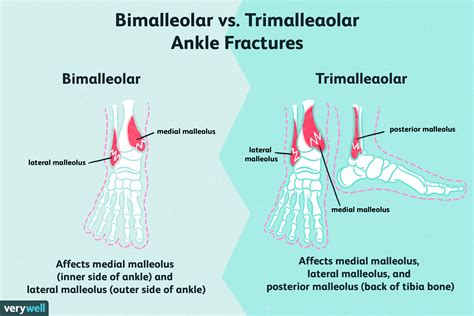 What Is The Posterior Lip Of Trimalleolar Fracture | Sitelip.org