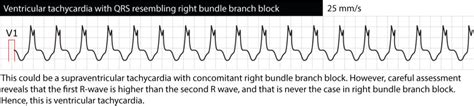 Ventricular tachycardia (VT): ECG criteria, causes, classification ...