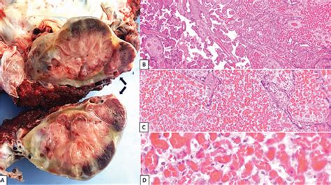 British Journal Of Midwifery - Giant placenta chorioangioma with ...