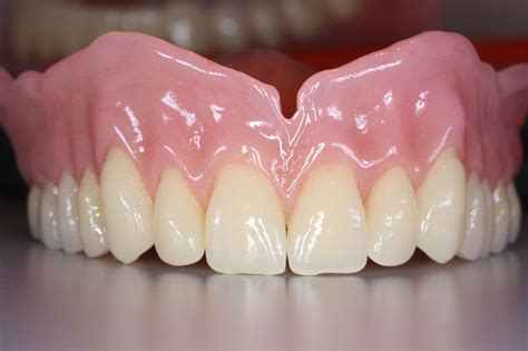 How To Take Care of Your Immediate Dentures - InHome Dentures