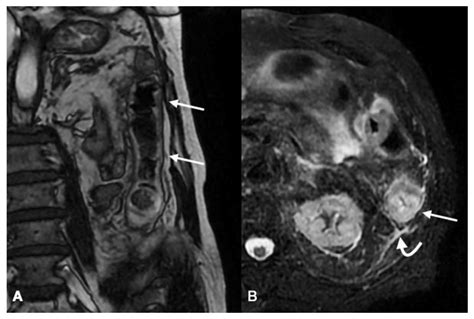 Large Bowel Ischemia/Infarction: How to Recognize It and Make Differential Diagnosis? A Review