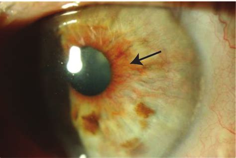 Uninflamed painful white eye showing fine abnormal " rubeotic " iris ...