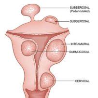 Fibroid Must know