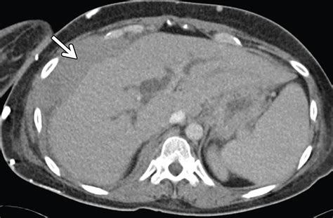 US of Right Upper Quadrant Pain in the Emergency Department: Diagnosing beyond Gallbladder and ...