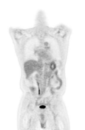 Phaeochromocytoma (MIBG scan) | Radiology Case | Radiopaedia.org