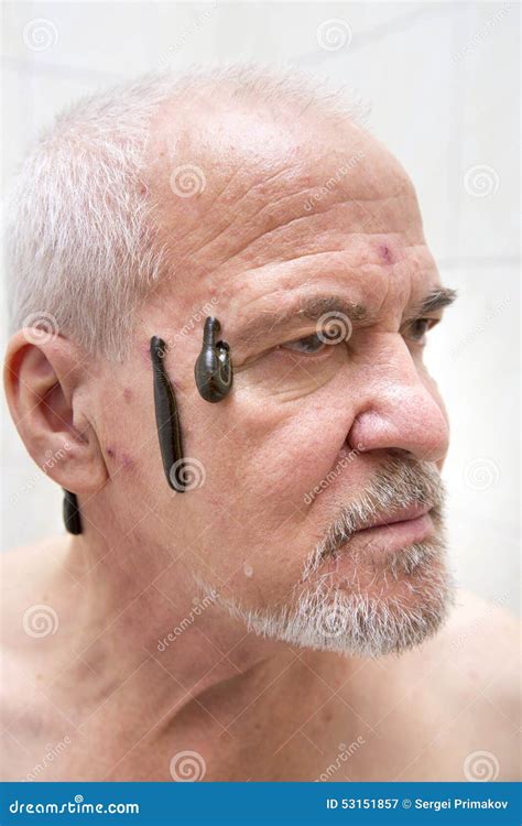 Leech therapy stock image. Image of detoxification, human - 53151857