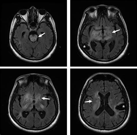 Cranial MRI before treatment: Diffuse abnormal signal in the pons,... | Download Scientific Diagram