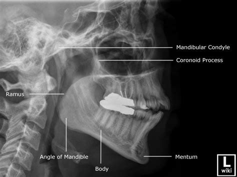 Radiographic Anatomy - Mandible Lateral | Facial bones, Diagnostic ...