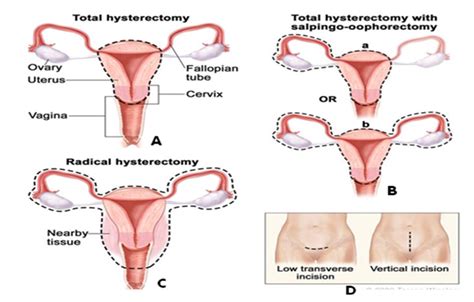 Treatment - OVARIAN CANCER