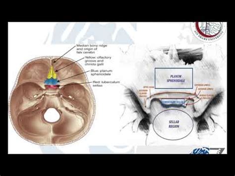 Brain Tumours (33): Meningiomas (7): Tuberculum Sellae/Planum Sphenoidale/Olfactory Groove - YouTube