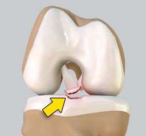 Tibial Eminence Fracture Lewisburg, WV | Knee Trauma Ronceverte, West Virginia