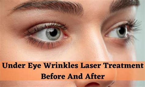 Under Eye Wrinkles Laser Treatment Before And After