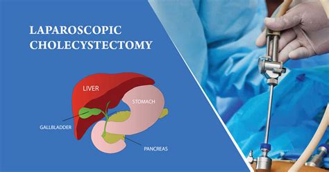 How To Perform A Laparoscopic Cholecystectomy - A Pictures Of Hole 2018