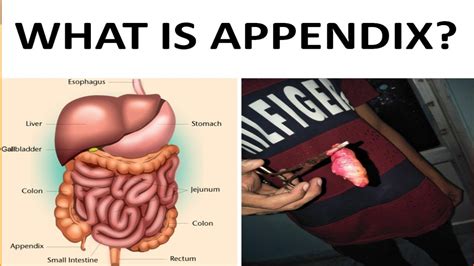 Appendix Pain Symptoms Appendix Pain Location