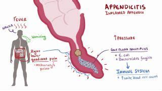 Rovsing’s Sign: What Is It, Procedure, Associated Appendicitis, and ...