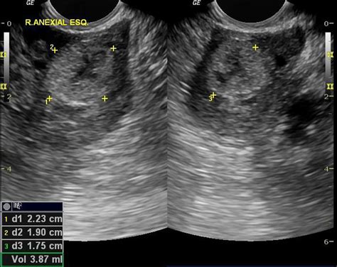 Ultrasound Leadership Academy: Ultrasound in Early Pregnancy — EM Curious