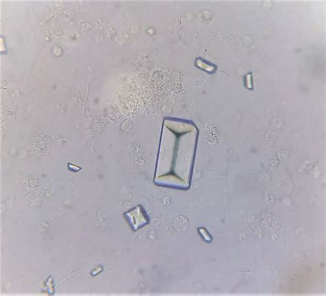 Triple Phosphate Crystals In Human Urine